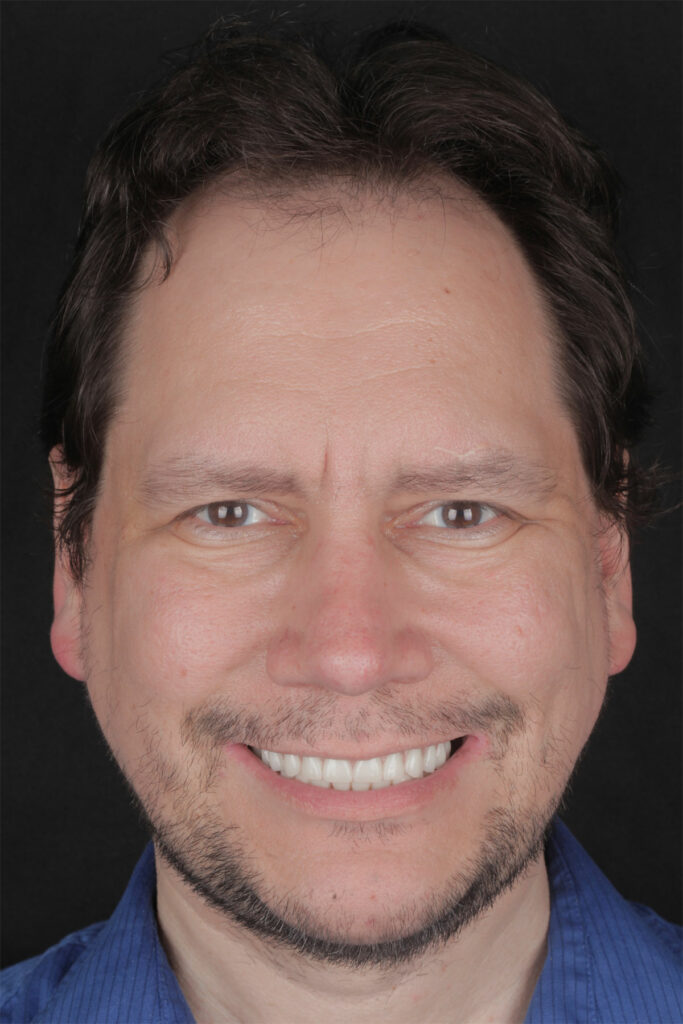 After All-on-4™ Immediate Implant Procedure