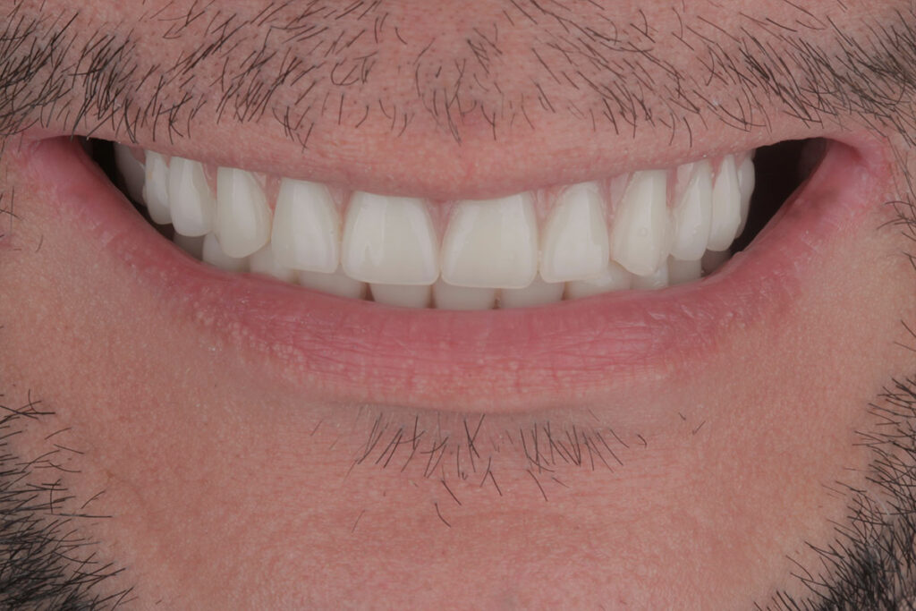 After All-on-4™ Immediate Implants dentures vs implants