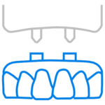 Denutres vs Implants Over Dentures and Veneers