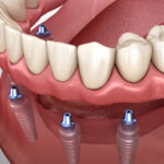 Image of an implant supported dental model.