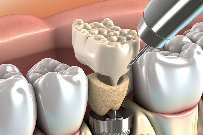 3d image of a dental implant