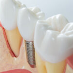 dental implant post digital model